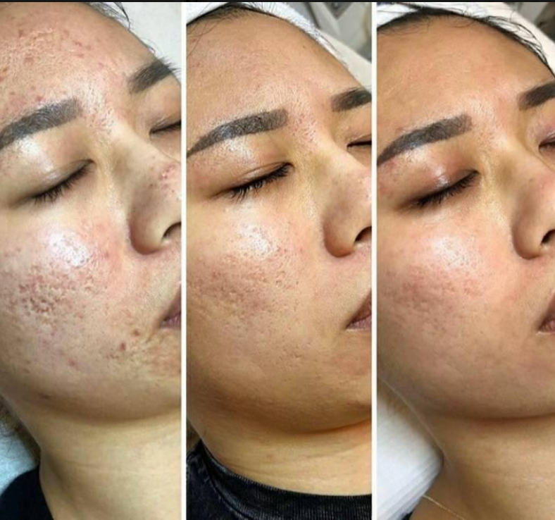 Кожа Resurfacing частичная машина RF Microneedle с холодной терапией инвазионной