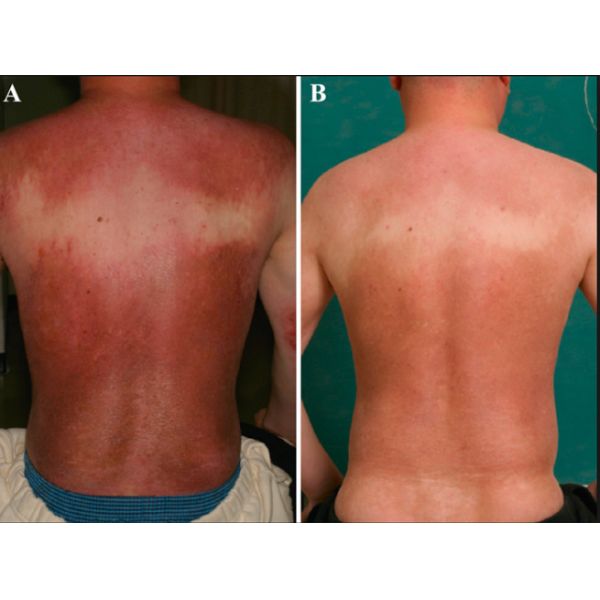 UVB Light Therapy Machine For Skin Pruritus Treatment With UVB Narrowband Lamp