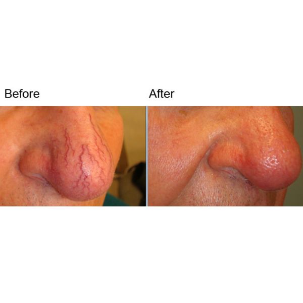 940nm At Home Spider Vein Removal Machine 15 Watt Pain Free Laser Therapy
