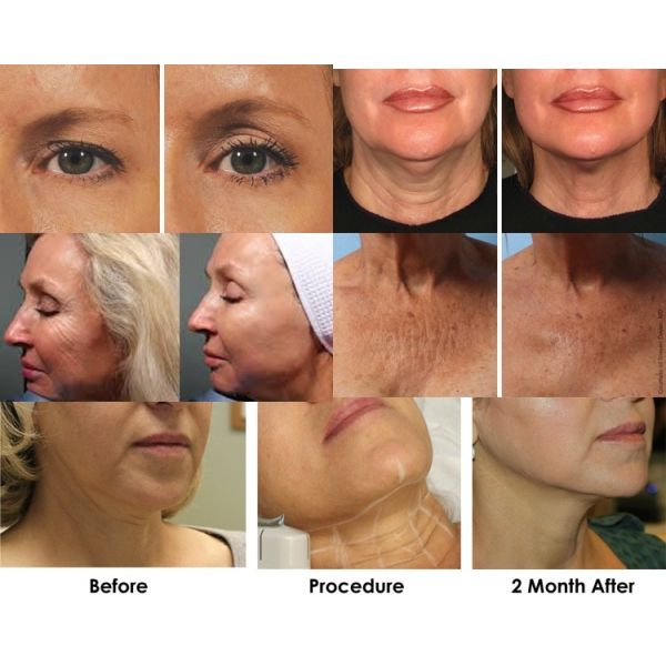 2018 high intensity focused ultrasound hifu,ultrasound hifu,skin tightener,face skin tightening,hifu korea