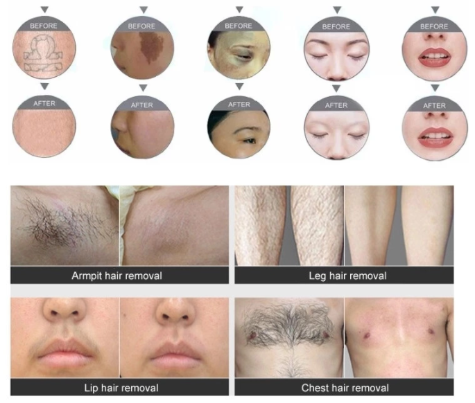 640nm 560nm Laser SHR Hair Removal Machine With CE ISO13485 Certificate