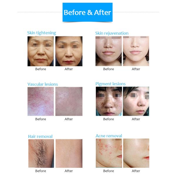 2 In 1 IPL Skin Rejuvenation Equipment , Nd Yag Laser Tattoo Removal Machine