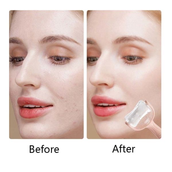 Cryotherapy Ice Roller For Face Eyes Silicone Face Massager Roller Puffiness Migraine Pain Relief And Minor Injury