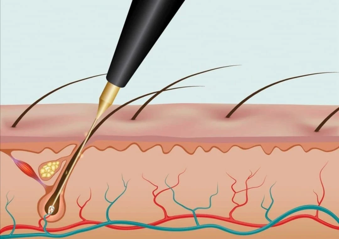 Needles RF 13.56MHz Radio Frequency Electrolysis for Safe Permanent Hair Removal and Vascular Therapy
