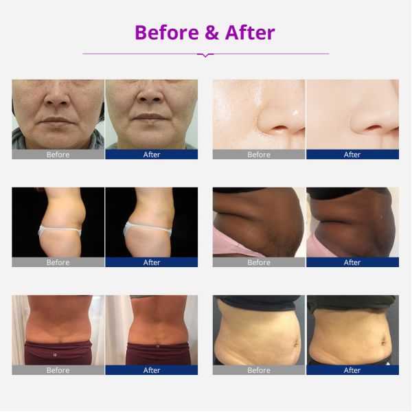 Машина 6 кавитации вакуума RF в 1 коже 40K затягивая формирующ оборудование красоты