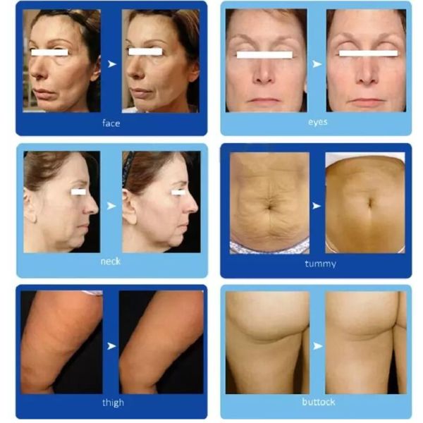 Effective BTL HIFU Facelift Machine For Wrinkle Removal / Body Slimming