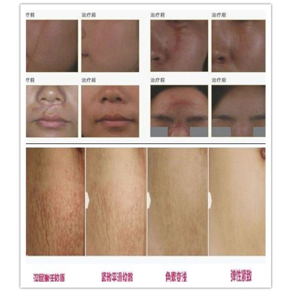 Medical CE Approval Fractional Co2 Laser Machine 635nm for Burnt / Surgery Scars