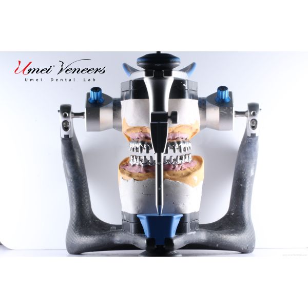 Biocompatible Titanium Marlow Bridge