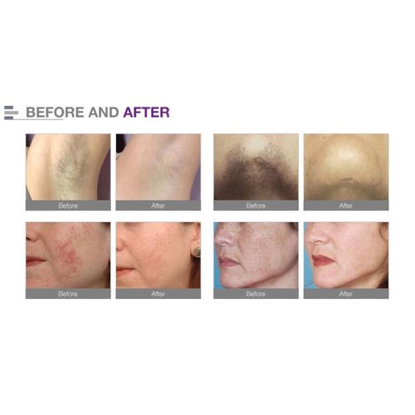 Pain Free SHR Hair Removal Equipment / Skin Rejuvenation Device With 2 Handpieces