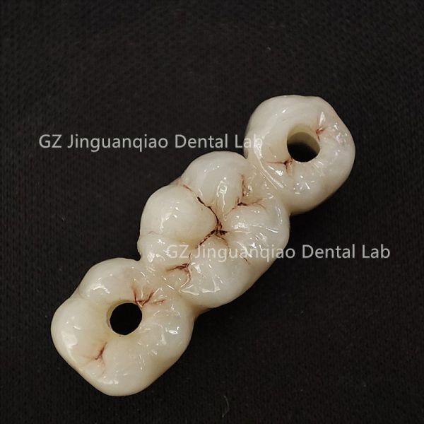 Titanium Abutment Dental Implant Screw Retained Crown 3D Laser Printing Customized