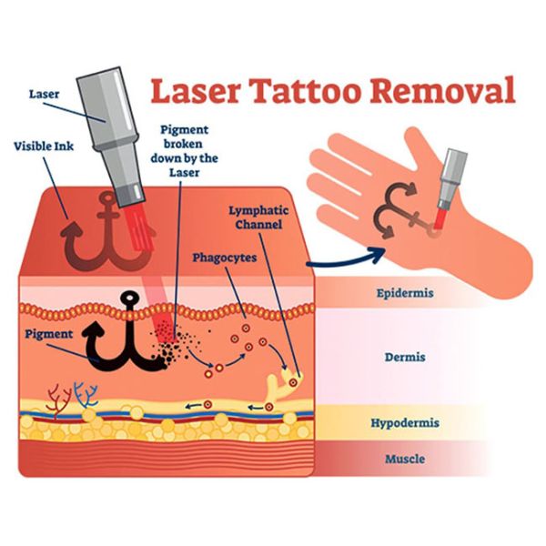 CE одобрил ультракрасную машину лазера ND YAG удаления угорь