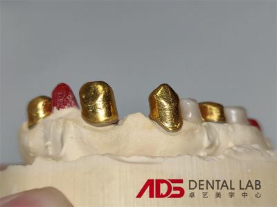 Dental Telescopic Crowns Prosthesis In Dentistry Customizable