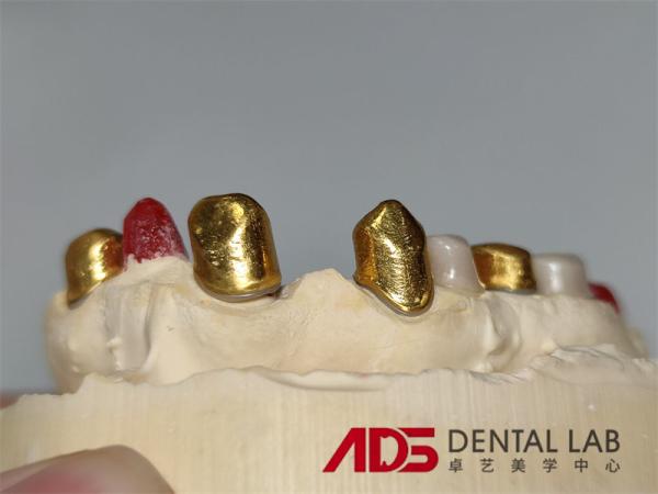Dental Telescopic Crowns Prosthesis In Dentistry Customizable