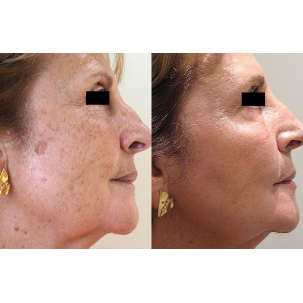 Portable SR HR VR E Light Laser Hair Removal Machine Mini Size 690-1200nm 2000W