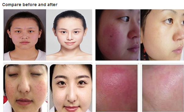 220V-50HZ Vascular Removal Machine 30Mhz Spider Vein Removal Device