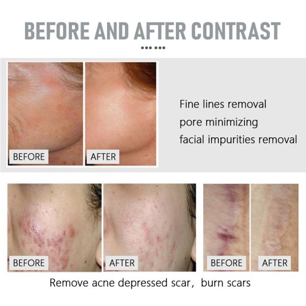 Q-Switch NO Fractional Co2 Laser for Laser Vaginal Tightening Machine Wrinkle Remover