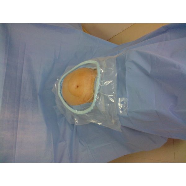 Хирургическое кесарева раздела c устранимое задрапировывает и одевает поддержку фильма рождения младенца медицинскую