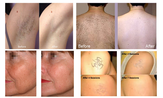 Tattoo Wrinkle Removal Laser Beauty Machine , 3s Elight IPL Shr Hair Removal Machine