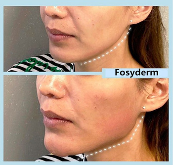 Анти- впрыска ХА иглы шприца заполнителей морщинки Хялуроник кислоты вызревания дермальная