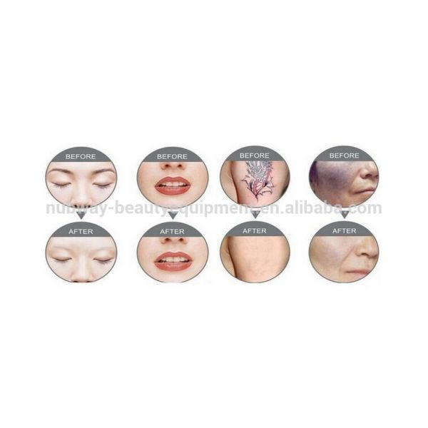 best tattoo remova/q switch nd yag tattooing remover laser equipment for beauty spa