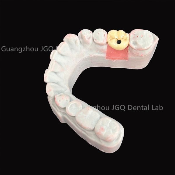 Dental Implant Screw Retained Crowns Titanium Bar Implant Supported Hybrid Denture