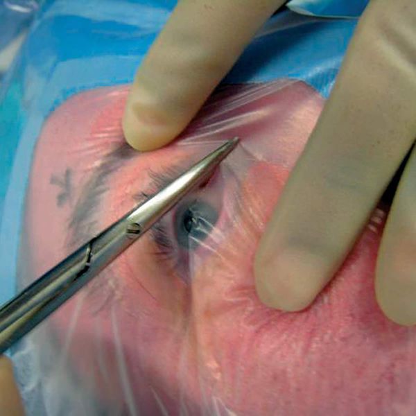 Ophthalmological Fenestrated Drapes Disposable With Integrated Incise Film