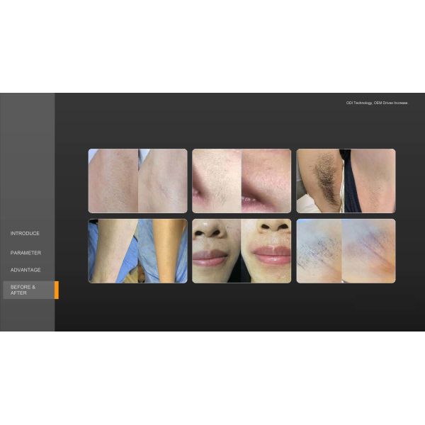 1200W Painless Long Term 4 Wavelength Diode Laser Hair Removal Machine