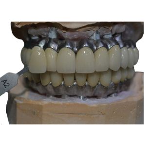 Коррозионностойкий Cr Co имплантирует поддержанный материал кроны металла биологический