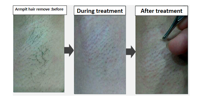 SHR IPL Hair Removal Machine Multi Functional Beauty Equipment