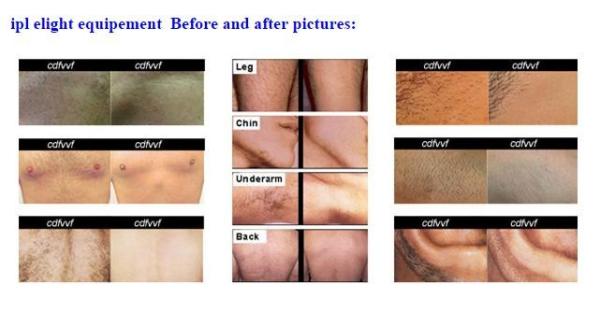 Salon use hair removal machine for face professional ipl laser hair removal and skin rejuvenation machine