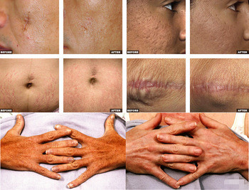Professional scar and acne removal Fractional Laser Co2/ Vigenal tightening,rejuvenation CO2