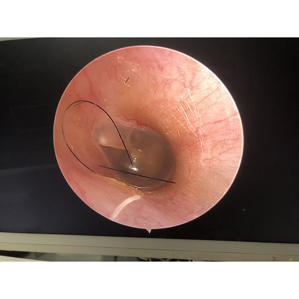 TUYOU Multi-Language Full HD Medical Endoscope Camera for ENT