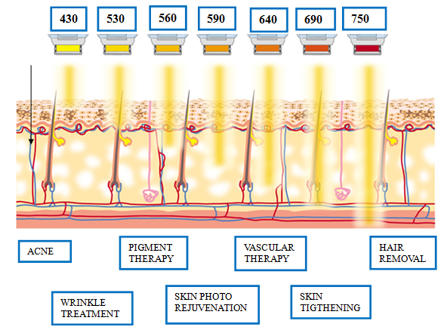 AFT EDF Shr Ipl Laser Hair Removal Equipment For Beauty Salon