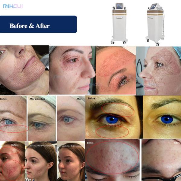 AU Plugs Jet Plasma Pen Para Apertar e Rejuvenescer a Pele Facial