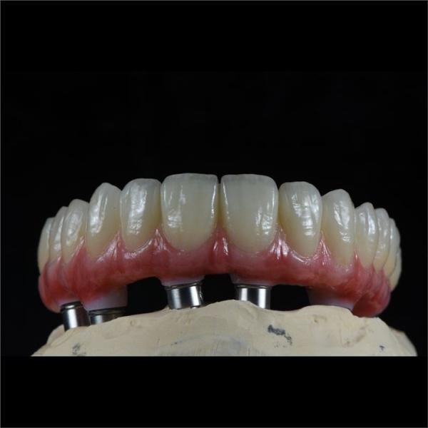 Fixed Restorations Full Arch Zirconia Implant Bridge Denture Teeth
