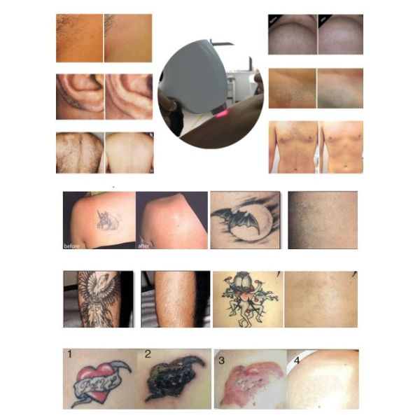 Double handles SHR Hair Removal Machine