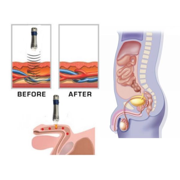 Машина терапией тела ESWT полная, машина удаления боли с 5 передатчиками
