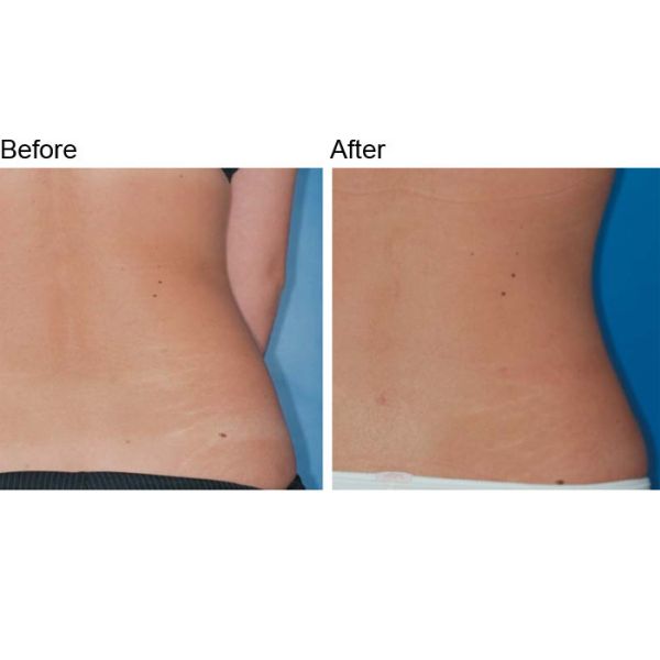 16 Watts Laser Lipolysis Machine 1470nm Lipo Laser Slimming Machine