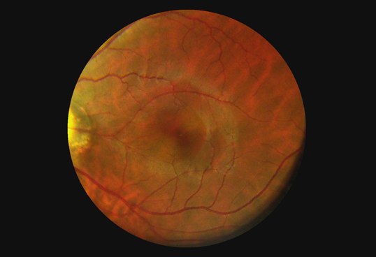 Handheld портативная офтальмическая камера Fundus цифров системы с высокой телемедициной объектива определения 1080P доступной