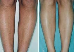 Medical CE Function IPL hair removal IPL Beauty laser machine
