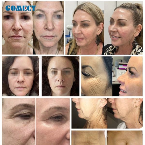 Золотая фракционная микроигла для красоты микроигла для подъема для очистки кожи