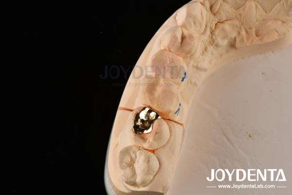 Abrasive Resistance Dental Wax Casting FMC Crown For Oral Clinical Repair