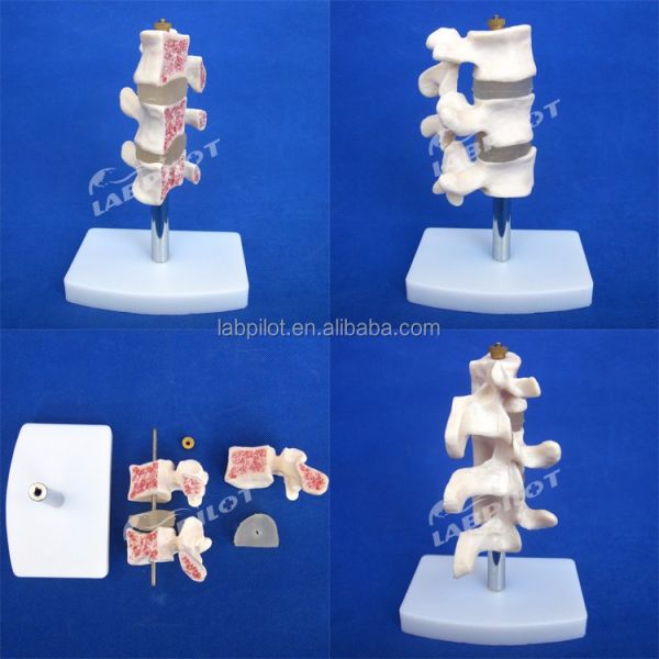 Advanced PVC Educational Models Cutaway Osteoporosis of Spine Lesions of Lumbar Vertebra