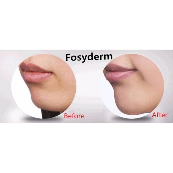 Женский заполнитель Хялуроник кислоты заботы лицевой для увеличения Чин продолжительного