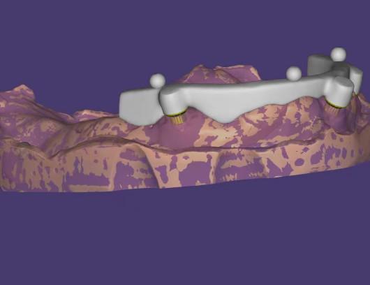 Customized Dental CAD CAM Design High Precision For Implant Supported Bar