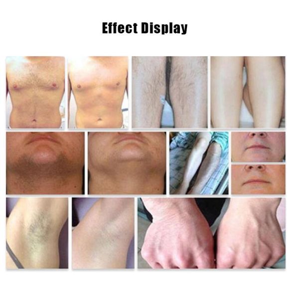 Professional 808 Nm/ 810 Nm Diode Laser Hair Removal Equipment For Full Body