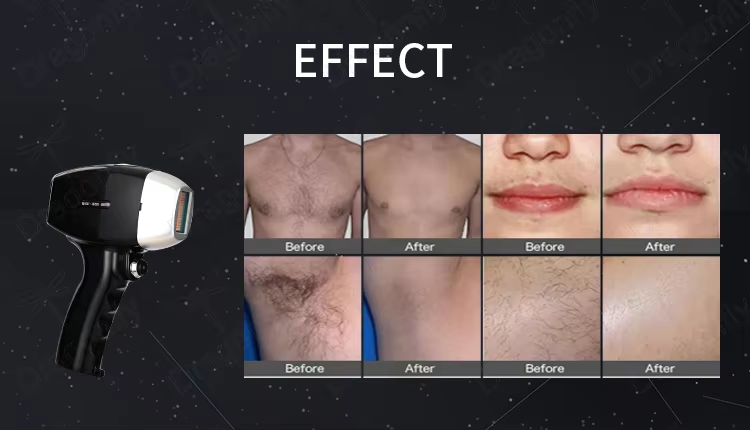 TEC конденсатор радиатор лазерная эпиляция 755 808 940 1064 нм диодный лазер