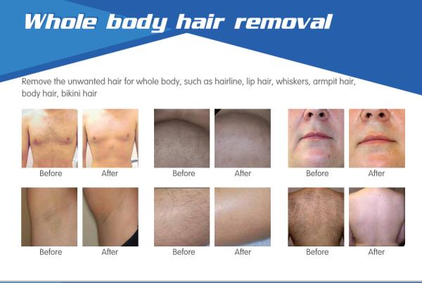 2016 hottest!!!SHR hair removal machine, IPL+RF +Elight treatment +shr , hot in USA,China manufacturer