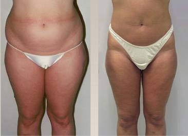 Vacuum Ultrasound Cavitation Slimming Machine Cellulite Removal LED Power 5 Watt