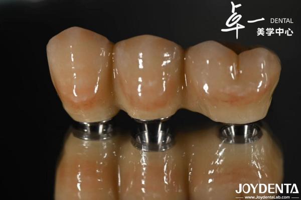 Rough Surface Design Dental Implant for Subcrestal Bone Level Titanium Material